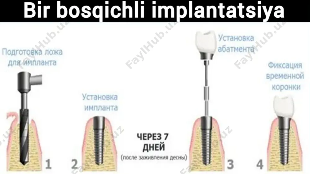 implantatsiya usullari - Page 5