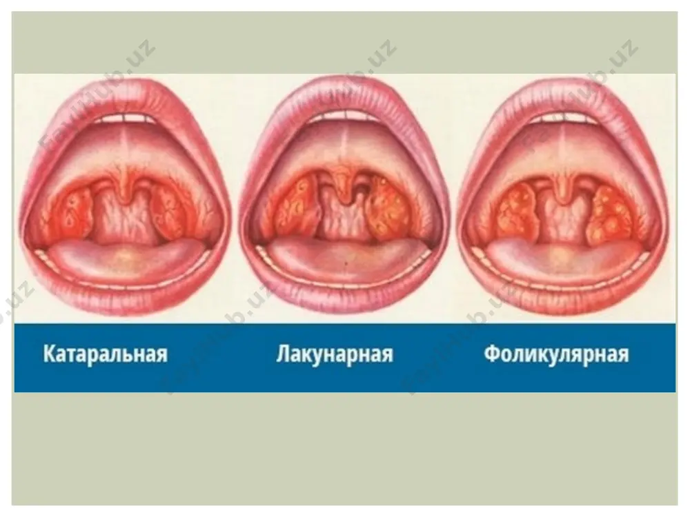 ангина - Page 4