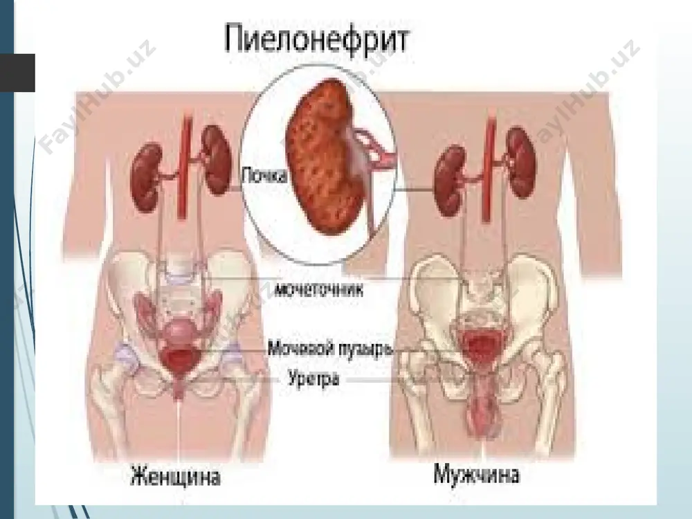 ina ko'paygan, lekin keyinchalik, uremiya rivojlanishi bilan keskin ko'payadi (20 000 va undan ortiq). 2.siydikda zo'rayish davrida ifodalangan proteinuriya (1-2 g/sut), bakteriuriya, leykotsituriya, tsilindruriya va kam hollarda gematuriya, ayniqsa siydik cho'kmasida “faol” (harakatchan) leykotsitlarni - shten- geymer-malbin xujayralarini aniqlash xarakterli, adis-kakovskiy yoki nechiporenko uslublarida siydik cho'kmasini miqdoriy tekshirish leykotsitlarni eritrotsitlarga nisbatan ko'pligini ko'rsatadi. siydikni bakteriologik tekshirish: siydik cho'kma- sidan oziqa muhitiga ekish, bakteriyalarni antibio- tikka sezgirligini aniqlash muhim ahamiyatga ega. zimnitskiy uslubida siydikni tekshirish buyrak faoliyati buzilishini ko'rsatadi. ekstretor urografiya konservativ davo antibakterial terapiya -penitsillin guruhi -sefalosporin guruhi -ftorxinolonlar -makrolidlar -uroseptiklar -dezintoksikotsion terapiya -immunostimulyatorlar -vitaminterapiya -sanatoriya-kurort terapiya na’matak klyukva profilaktikasi -siydik yo’llaridagi infeksiya o’chog’ini bartaraf etish -tana reaktivligini kuchaytirish -o’tkir piyelonefritni to’liq davolash -homiladorlarda belgisiz bakteriuriyani vaqtida aniqlash image1.png image2.png image3.png image4.jpeg image5.jpg image6.jpg image7.jpg image8.jpg image9.jpeg image10.jpeg image11.jpeg image12.png image13.png image14.jpg image15.png image16.jpg image17.jpg image18.jpg image19.jpg