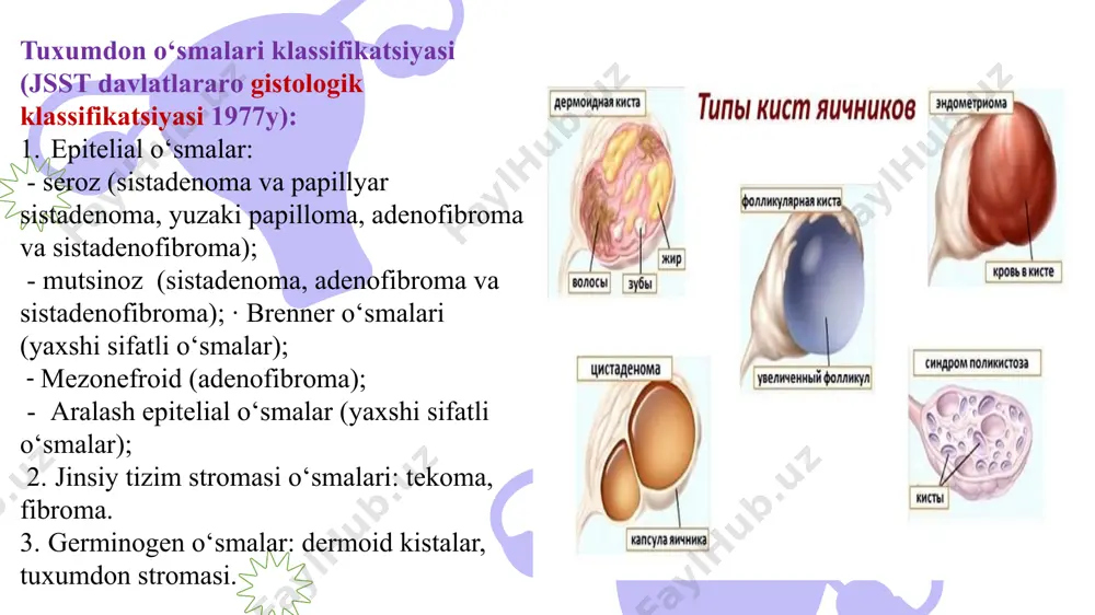 qatnashadi. dermoidlar sharsimon silliq o‘smalardan iborat bo‘lib, sekin o‘sadi, harakati chegaralangan va ko‘pincha bachadon bilan qovuq o‘rtasidagi bo‘shliqdan joy oladi. dermoid kista kesilganda suyuqlik to‘la xaltachaga o‘xshaydi. bu suyuqlik, uy haroratida qotib yog‘simon massa hosil qiladi. ko‘pincha yog‘simon massa tarkibida inson embrional taraqqiyotining birlamchi davridagi elementlar – soch, tish, tirnoq va shunga o‘xshash elementlar topiladi. blastomatoz kistomalar chin o‘smalar bo‘lib, tuxumdon o‘smalarning 66% ni tashkil qiladi. to‘qimalar proliferatsiyasi, bo‘shliqlarning suyuqlik bilan to‘lishi tufayli o‘smalar o‘sishi kuzatiladi. turli-tuman to‘qimalardan o‘sishi bo‘yicha – epitelial, biriktiruvchi to‘qimadan tuzilgan, teratoid va gormonal tuxumdon o‘smalariga ajratiladi. chin o‘smalar, o‘z navbatida, xavfsiz va xavfli o‘smalarga bo‘linadi. xavfsiz o‘smalar tuxumdon tashqarisiga chiqmay o‘sib boradi. oddiy seroz kistomalar eng ko‘p uchraydigan tuxumdon o‘smalaridan biri hisoblanadi. uning hajmi 8 sm dan 30–40 sm gacha kattalashishi, hatto butun qorin bo‘shlig‘ini egallashi mumkin. kistoma, odatda, bir kamerali, po‘stlog‘i yupqa, tekis shar shaklida, elastik konsistensiyali bo‘ladi. uning bo‘shlig‘ida seroz suyuqligi yig‘iladi. o‘sma …