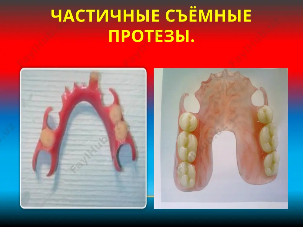 бов. следует дать ре­комендацию тренировать функцию чтением вслух. рекомендации больному и правила пользования съемными протезами процесс адаптации пациентов к протезам. различают три фазы адаптации к зубному протезу первая фаза - раздражения. наблюдается в первый день наложения протеза и характеризуется повышенной саливацией, снижением эффективности жевания, изменением вторая фаза - частичного торможения. у большинства больных она длится от 3 до 7 дней и характеризуется умеренной саливацией, восстанов­лением дикции и исчезновением напряжений мягких тканей, восстановлением эффективности жеванияречи. . третья фаза - полного торможения, длится от 7 до 30 дней. больной не ощущает неудобств от протеза. гигиена полости рта и уход за протезами. коррекция съемных протезов. прогноз. отсутствие соответствующего ухода за протезами яв­ляется одной из причин воспаления слизистой обо­лочки протезного ложа. протезы следует как можно чаще, а после приема пищи обязательно, чистить зубной щеткой в проточной воде с зубным порошком или пастой. в случае обнаружения травмированных участ­ков слизистой оболочки протезного ложа необходимо их точно …