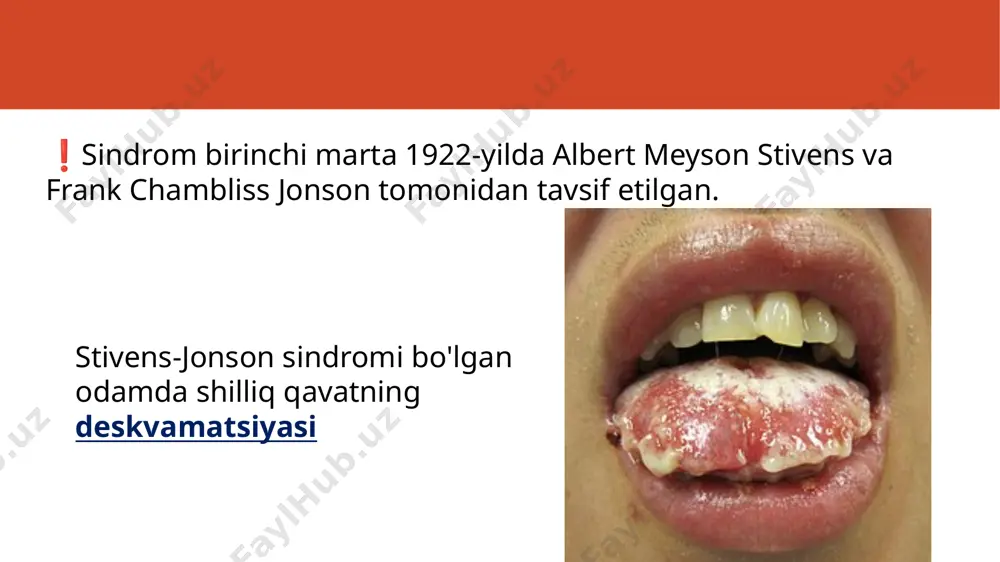 stiven-jonson sindromi - Page 5