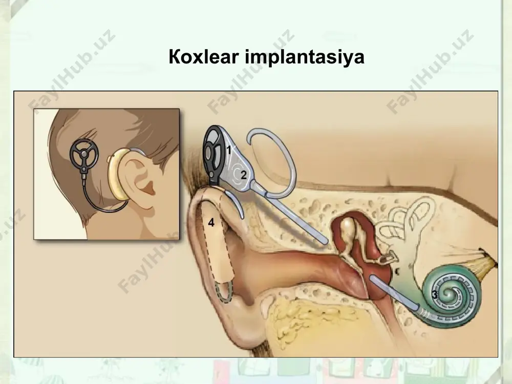 koxlear implant - Page 5