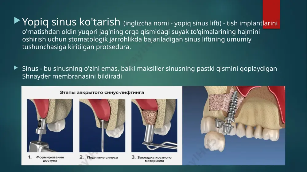 teshiklar hosil bo'ladi (implantlar soni uchun). shifokor sinus membranasini shikastlamaslik uchun juda ehtiyotkorlik bilan harakat qiladi (buning uchun kt ma'lumotlari kerak). 2-bosqich: suyakda hosil bo'lgan "o'tish joylari" orqali kerakli asboblar to'plami kiritiladi va sinusning pastki qismi ehtiyotkorlik bilan siljiydi, 3-bosqich: hosil bo'lgan bo'shliq asta-sekin sun'iy suyak va fibrin birikma bilan to'ldiriladi, 4-bosqich: transplantatsiya qilinganidan so'ng darhol implantlar o'rnatiladi – osteoplastika o'tkaziladigan teshiklar, ularning o'lchamlari maxsus yaratiladi. 5-bosqich: kollagen membranasi qo'llaniladi (u ekilgan suyakni ushlab turadi va regeneratsiyaga yordam beradi), tish milki tikiladi. ochiq va yopiq turdagi protseduralardagi farqlar ochiq va yopiq sinusni ko'tarish o'rtasidagi farq nima? har bir navning barcha xususiyatlari yuqorida batafsil tavsiflangan. ammo, qisqacha aytganda, operatsiyaning ochiq turi bilan jag ' suyagida katta "oyna" hosil bo'ladi, u orqali sinusning pastki qismi ko'tariladi va greft kiritiladi. bu ko'proq shikast etkazadi, tiklanish uzoqroq davom etadi – asoratlar tez-tez uchraydi, ovqatlanish cheklovlari ko'proq. ochiqdan farqli o'laroq, yopiq turdagi bunday "oyna" kerak …