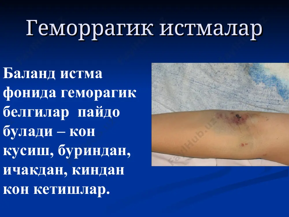 ой кожей. геморрагик конъюнктивит (конъюнктива ва склерага кон куюлишлар) геморрагик истмалар * слизистые часто являются местом кровоизлияний при вирусных геморрагических лихорадках. геморрагический конъюнктивит (кровоизлияния в конъюнктивы и склеры) обычно отмечается при нескольких из них. мелена (ичакдан кон кетиш) ошкозонда кон кетиш геморрагик истмалар * frank желудочно-кишечное кровотечение могут вызывать (мелену) кровавый понос или (гематемезис) кровавую рвоту. они появляются в поздний период болезни и обычно являются грозными признаками. бостонская (энтеровирусная) экзантема юкиш манбаи - касал одам ва вирусташувчи. баланд истма 39-40°с, юкори интоксикация (бош огриши, холсизликкусиш). тошма – бир вактда бутун баданда пайдо булади, 1- 2 кун туради. кичиш, кипикланиш, пигментация кузатилмайди, огиз шиллик каватида догли энантема еки везикула хос. диагностикаси жуда кийин. серологик усул (ифа) кулланилади.