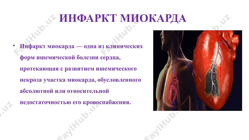 функции проявляется гипокинезией, акинезией или дискинезией (пародаксальное выпячивание части инфаркта во время систолы). чем больше участок поврежден тем меньше насосная функция лж: если сократимость лж снижается более 10% , то снижается фв (фракция выброса). если превышает 15% - то повышается последнее диастолическое давление и объем лж. если превышает 25% - проиходит отёк легкого если превышает 40% возникает кардиогенный шок. уменьшение зоны повреждения улучшает патофизиологическое и клиническое состояние больного. классификация инфаркта миокарда i. по величине и глубине поражения сердечной мышцы (по данным экг): трансмуральный (с зубцом q): - с подъемом сегмента st в первые часы заболевания и формированием зубца q в последующем. эквиваленты зубца q – изменения амплитуды зубца r нетрансмуральный (без зубца q) : интрамуральный - им с подъемом сегмента s-т протекает благоприятно, но с высокой вероятностью рецидива, показано тромболитическая терапия субэндокардиальный - им с депрессией сегмента s-т имеет тяжелое течение, прогностически неблагоприятный 15 ii. по характеру течения заболевания: первичный …