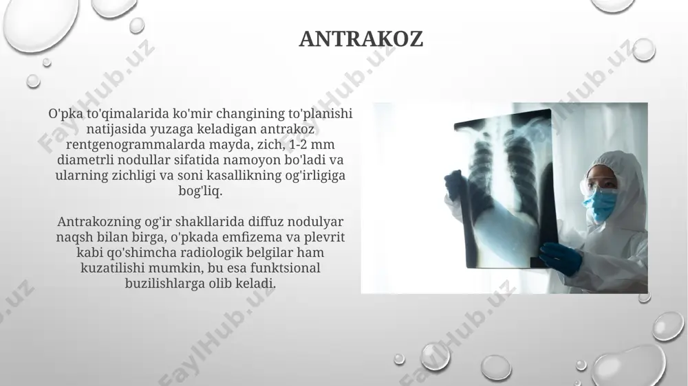 ish organlarining shikastlanishini, shuningdek, suyak ko'migining gipoplaziyasini ko'rsatadi. suyak kasalliklari kasbiy zaharlanish tufayli kelib chiqqan suyak saratoni rentgenogrammalarda litik yoki sklerotik o'zgarishlar, suyaklarning deformatsiyasi va yumshoq to'qimalarning infiltratsiyasi kabi ko'rinishlarda namoyon bo'lishi mumkin. suyak osteoporozi rentgenogrammalarda suyak zichligining kamayishi, trabekulyar tuzilmaning yupqalanishi va kortikal qatlamning ingichkalashuvi bilan namoyon bo'ladi, bu esa kompressiv sınıqlar xavfini 2-3 barobar oshiradi. qalqonsimon bez kasalliklari qalqonsimon bezning diffuz toksik kattanishi (basedow kasalligi) radiologik tekshiruvda bez hajmining 1,5-2 baravar kattalashganligini, uning tuzilmasining notekisligini va qon oqimining kuchayganligini ko'rsatishi mumkin. qalqonsimon bezning tugunli toksinozlari ultratovush tekshiruvida 3 mm dan katta tugunlar, ularning chegaralarining aniq yoki notekis ekanligi, shuningdek kalsifikatlar mavjudligi bilan xarakterlanadi. pnevmokoniozlar antrakoz kabi ba'zi pnevmokoniozlar birinchi bosqichlarda asemptomatik bo'lishi mumkin, ammo yuqori darajali ta'sir bilan radiologik o'zgarishlar aniqlanadi. pnevmokoniozlarning radiologik belgilarida, nodullar, fibroz va emfizema kabi o'zgarishlar 1-4- bosqichlarda tasvirlanadi, bu esa kasallikning og'irlik darajasini aks ettiradi. kasbiy kasalliklarning radiologik belgilari radioaktiv moddalar bilan ishlash …