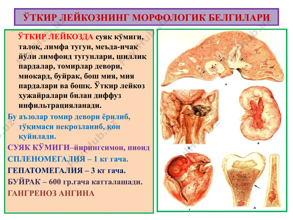 а эритроцитлар мембранаси ригидланади. эритроцитлар талокда секвестрланиб 20кунда нобуд булади ригидланган уроксимон эритроцитлар капиллярларга тикилади эритроцитлар заряди узгариб эндотелийга ёпишади коннинг ивиши тезлашади. гемоглобинопатия уроксимон хужайрали анемияда патанатомия: макро: юрак, жигар, буйрак ёгли дистрофия окибатида оч сарик рангли. талок- спленомегалия (500г) инфаркт учоклари. расм микро: юрак, буйрак эгри-бугри каналчаларида, жигар паренхиматоз ёгли дистрофия. конда уроксимон эритроцитлар ва ретикулоцитоз. суяк кумиги гиперплазияси, экстрамедуляр гематопоэз. умумий гемосидероз, гемохроматоз. расм 3. талассемия бу- гемоглобиннинг a-глобин ва в-глобин занжирлари синтези бузилишидан ривожланадиган ирсий анемиядир. сабаби ва механизми: гемоглобин генлари мутацияси, делецияси ва транскрипцияси, бекарон рнк синтезланиши. патнатомияси: макро: спленомегалия, гепатомегалия, кумик гиперплазияси, суякнинг юпкаланиши, гемосидероз, сариклик. микро: конда- аницитоз, пойкилоцитоз, ретикулоцитоз. эктрамедуляр гематопоэз. расм iii. дисэритропоэтик эритропоэз бузилиши окибатида бошланадиган анемиялар суяк кумигининг гемопоэз учун зарур моддалар билан тегишлияа таъминланмагинлигидан келиб чикувчи анемиядир. турлари: 1.fe танкислигига боглик анемия 2.мегалобластик анемия 3. гипопластик ва апластик анемия 4.миелофтиз анемия 1. темир танкислигига боглик анемия сабаби: а) …