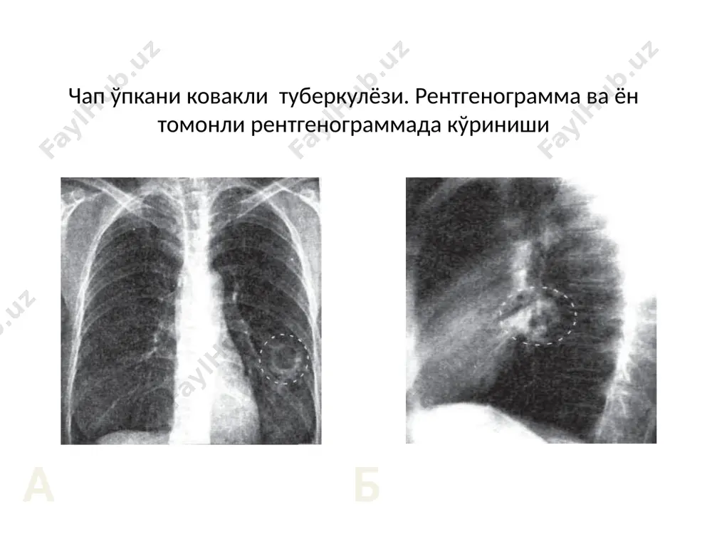 ўнг ўпкани ковакли туберкулези - Page 4