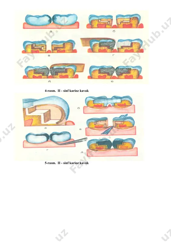 qotish maqsadida, uning ustidan sun’iy dentin qavati ajratuvchi taglik sifatida qo’yiladi. sun’iy dentin ustidan esa fosfat – tsement quyiladi. taglik kovak tubi va devoriga tekis xolda surtilib, qo’yiladi. ajratuvchi taglik gladilka va shtopfer bilan kovakka kiritilib, tekislanadi. doimiy plomba qo’yish.qorilgan doimiy plomba ashyosi shakllantirilgan kariyes kovakka kiritiladi va ajratuvchi taglik ustidan qo’yiladi. gladilka va shtopfer yordamida plomba tekislanadi va jipslashtiriladi. doimiy plomba tishni anatomik shaklini tiklashi kerak. doimiy plomba ashyosi sifatida kompozit plomba ashyolari, amalgama va shisha ionomer tsementlar qo’yiladi. plomba qo’yilgandan so’ng tishlar yumilib, antagonist tish bilan xosil bo’lgan jipslashish tekishiriladi. ortiqcha plomba ashyosi qora qogoz bilan tekshirilib, karborund tosh bilan tekislanadi. plombaga pardoz berish. doimiy plombani pardozlashda borlar, karborund toshlar qo’llaniladi. silliqlash maksadida finir, polir va rezinali qalpoqchalar ishlatiladi. pardozlangan plomba silliq, tishlaganda antogonist tish bilan odatiy prikusda bo’lishi lozim. image3.png image4.png image5.png image6.png image7.png image8.png image9.png image10.png image11.png image12.png image1.png image2.png