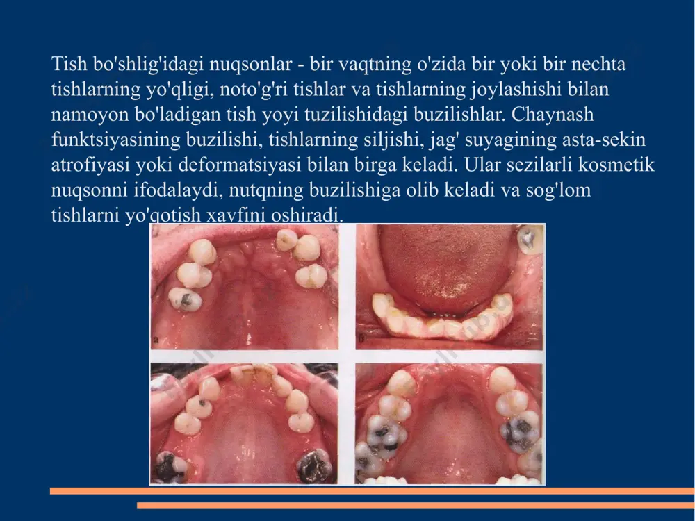 ga ega: • qo'llab-quvvatlash; • ushlab turish. magnit ushlagichlardan foydalanish quyidagi afzalliklarga ega: • doimiy saqlash; • eksenel yuk; •faollashtirish shart emas; • tayanchlarning koaksiyalligiga muhtoj emas; • oddiy og'iz gigienasi. magnit ushlagichli olinadigan protezlar tarqatiladi qo'llab-quvvatlovchi tishlarga chaynash bosimi, ishonchli og'iz bo'shlig'ida o'rnatiladi, ammo etishmasligi tufayli barqarorlashtiruvchi qism gorizontal holatda beqaror yuk (protez asosining lateral siljishi mumkin). shuning uchun, magnit qisqichlardan foydalanish uchun cheklov alveolyar tizmalarning keskin atrofiyasidir. bunday qisqichlar asosan qo'shimcha element sifatida ishlatiladi. tish olishga qarshi ko'rsatmalar yurak-qon tomir tizimi kasalliklari (gipertenziv inqiroz, angina pektorisining kuchayishi, revmatizm, septik endokardit, yurakning aniq dekompensatsiyasi, atriyal fibrilatsiya va yurak etishmovchiligi bilan asoratlangan taxikardiya) va buyraklar; - yuqumli gepatitning o'tkir shakli; - agranulotsitoz va o'tkir leykemiya; - gemorragik kelib chiqishi diatezi; - ruhiy kasallikning kuchayishi; - miyaning qon aylanishining buzilishining o'tkir shakli; - o'tkir yuqumli kasalliklar; - yiringli sekretsiyalar bilan yallig'lanish jarayonlari - flegmona va xo'ppozlar, jag', qizilchadan tashqari; - 1, …