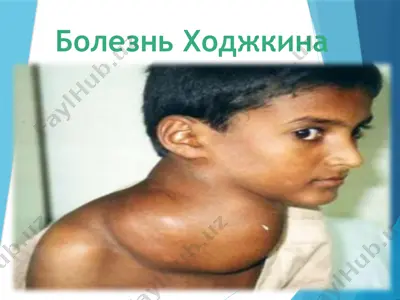 лимфогранулематоз или болезнь ходжкина — PPT