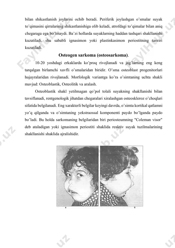 ik jihatdan aniq chegaralarsiz, zich qo’shimchali, noto’g’ri o’choq bilan ifodalanadi. fibrosarkoma-bu suyak iligi yoki periosteumning biriktiruvchi to’qima stromasidan rivojlanadigan xavfli o’sma. o’smaning hujayra komponenti ko’payadigan fibroblastlar xisoblanadi. differensiatsiyalangan fibrosarkoma mavjud bo’lib, u tolalarning tartibli joylashuvi va kollagen tolalarining ko’pligi bilan ajralib turadi, kamdifferensiatsiyalangan turi esa hujayralarning tolalardan ustunligi bilan farqlanadi. o’sish manbasiga qarab (suyak iligi yoki periosteumning biriktiruvchi to’qima stromasi) markaziy va periferik shakllar ajratiladi. markazda joylashgan o’simta bilan yumaloq shakldagi ma’rifat markazi aniqlanadi va o’simtaning periferik joylashuvi bilan jag’ning shakllanishining yumshoq to’qima soyasi va marginal vayron bo’lishi aniqlanadi. fibrosarkomaning o’ziga xos rentgen xususiyati deb nisbatan aniq konturli shakllanishni hisoblash mumkin. miksosarkoma juda kam uchraydigan o’sma bo’lib, odatda jag’ning shilliq qavatida joylashgan. o’smaning o’ziga xos morfologik xususiyati yulduzsimon, o’rgimchakka o’xshash hujayralar bo’lib, ular o’z o’siqlari bilan anastomoz hosil qiladi va shilliqni to’plashga qodir. strukturaviy yelementlar oz miqdorda kollagen bo’lgan gomogen interstitsial substansiyada joylashgan. markazda joylashgan o’smalardagi rentgen tasviri ingichka suyak …