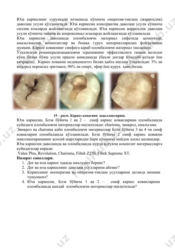 апиясининг эффективлигини витал бўяш синамасини ўтказиб аниқланади. таркибида фтор сақловчи тиш пасталаридан фойдаланиш тавсия этилади. тишда кариес коваги бўлган тишларни даволаш учун патологик ўзгариш содир бўлган тўқималарни олиб ташланади. юза кариесни нооператив ва оператив-тиклаш усуллари орқали даволаш мумкин. юза кариеснинг ўткир кечишида кўпинча нооператив (консерватив) даволаш усули қўлланилади. юза кариеснинг сурункали кечишида кўпинча оператив-тиклаш (жарроҳлик) даволаш усули қўлланилади. юза кариесни консерватив даволаш усули кўпинча силлиқ юзаларда жойлашганда қўлланилади. юза кариесни жарроҳлик даволаш усули кўпинча чайнов ва аппроксимал юзаларда жойлашганда қўлланилади. юза кариесни даволашда пломбаловчи материал сифатида цементлар, амальгамалар, композитлар ва бошқа гуруҳ материалларидан фойдаланиш мумкин. кариес ковакнинг синфига қараб пломбаловчи материал танланади. ўтказилган реминерализацияловчи терапиянинг эффективлиги тишни метилен кўки билан бўяш усули орқали аниқланади (баъзи доғлар йўқолиб кетади ёки кичраяди). кариес ковакни медикаментоз билан қайта ишлаш ўтказилади: 3% ли водород пероксид эритмаси, 96% ли спирт, эфир ёки қуруқ ҳаво билан. 15 – расм. кариоз ковагини шакллантириш. юза кариесни, блэк бўйича …
