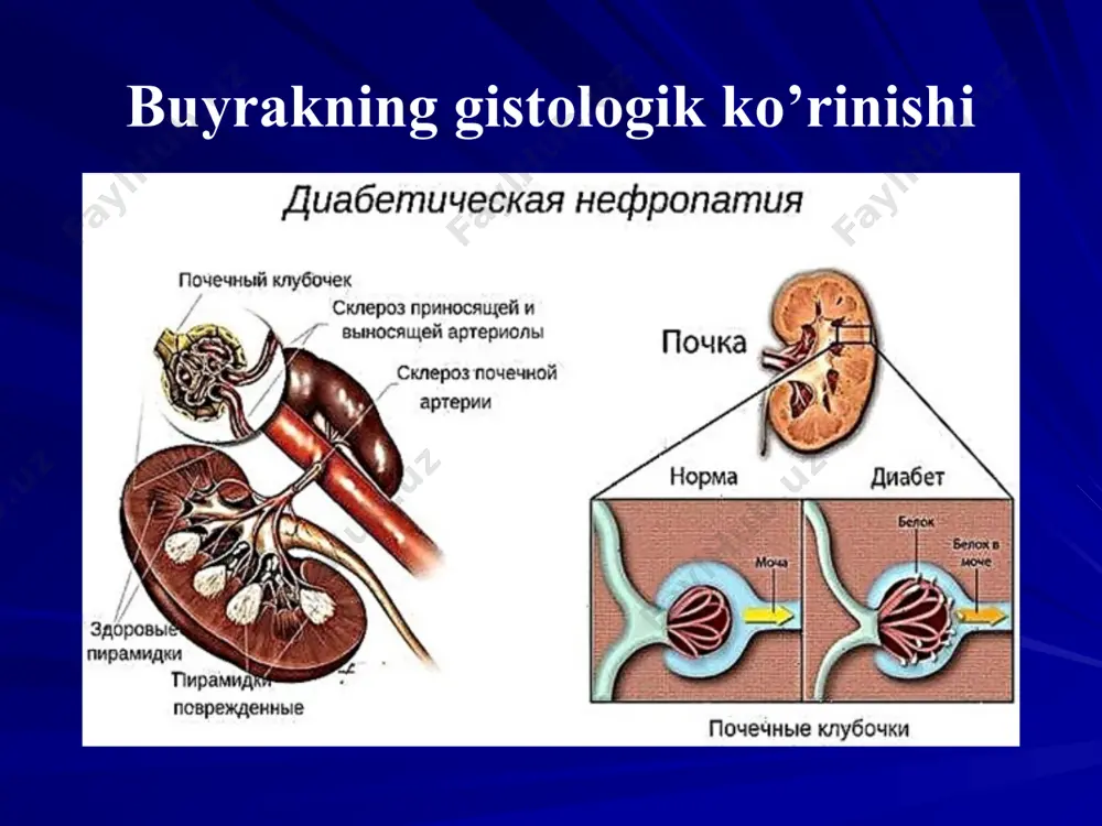 jada kamayadi, bu esa organizmdagi patologik o'zgarishlarni keltirib chiqaradi. siydikda oqsil, qon va hatto tsilindrlar aniqlanadi, bu ekskretsiya tizimining disfunktsiyasini aniq ko'rsatib beradi. odatda, kasallikning terminal bosqichiga o'tishi besh yildan yigirma yilgacha davom etadi. agar buyrakni ushlab turish uchun o'z vaqtida choralar ko'rilsa, tanqidiy vaziyatlardan qochish mumkin. kasallikning tashxisi va davolash asemptomatik boshlanishi juda qiyin, chunki diabetik nefropatiyaning dastlabki bosqichlarida asosan tasodifan aniqlanadi. shu sababli, diabet kasalligi tashxisi qo'yilganida, siydik miqdorini kuzatib borish va muntazam ravishda zarur testlarni o'tkazish kerak. diabetik nefropatiya uchun xavf omillari kasallikning namoyon bo'lishining asosiy sabablarini ichki tizimlarning ishlarida izlash kerakligiga qaramasdan, boshqa omillar bunday patologiyani rivojlanish xavfini oshirishi mumkin. qandli diabet bilan og'rigan bemorlarni davolashda ko'plab shifokorlar genitouriya tizimining holatini kuzatishni va tor mutaxassislar (nefrolog, urolog va boshqalar) bilan muntazam ravishda tekshiruv o'tkazishni tavsiya qiladilar. kasallikning rivojlanishiga yordam beradigan omillar: muntazam va nazoratsiz yuqori qon shakar; hatto qo'shimcha muammolarga olib kelmaydigan anemiya (kattalardagi bemorlarda gemoglobin …