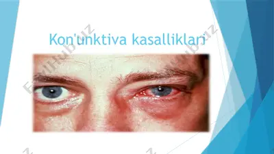 kon'unktiva kasalliklari — PPTX