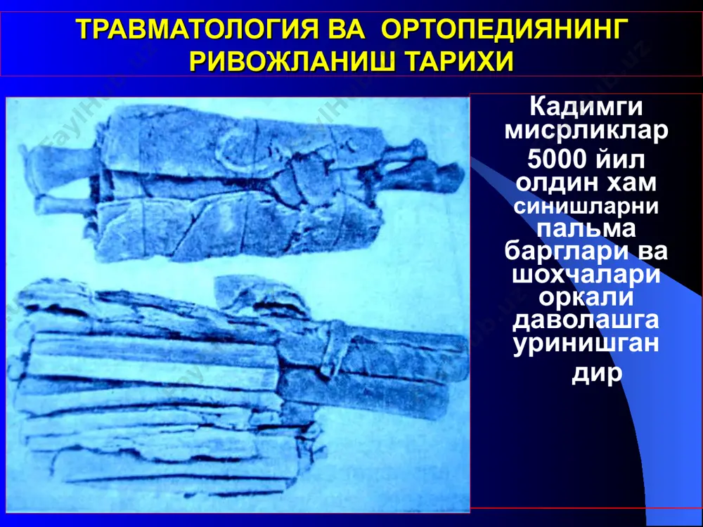 боғлами 1852 йилда ишлаб чиқилди. уни биринчи бўлиб ҳарбий дала шароитида н.и. пирогов қўллади 1854 й. травматология ва ортопедиянинг ривожланиш тарихи xviii аср охирида биринчи ортопедик касалхоналар ташкил қилина бошлади. венель (1789) швейцарияда биринчи ортопедик касалхона очди гейне (1812) вюрубургда, лейтгоф (1818) любекда, де роон (1850) петербургда. травматология ва ортопедиянинг ривожланиш тарихи николай иванович пирогов (1810 - 1881 й.й.) 26 ёшида профессор бўлган н.и. пирогов суяк пластик ампутацияларини ишлаб чиқди. травматология ва ортопедиянинг ривожланиш тарихи 1893 й. в.и.кузьмин биринчи бўлиб никелли штифтлар билан интрамедулляр остеосинтезни ўтказди. усул бир неча вақт қолиб кетди, лекин 1940 йилда у кюнчер (kuntscher) томонидан қайта очилди ва кенг қўлланила бошланди. 1946 йилда россияда биринчи бўлиб я.г. дубров интрамедулляр остеосинтезни амалга оширди. травматология ва ортопедиянинг ривожланиш тарихи wilhelm conrad rеоntgen (1845 -1923) on november 8, 1895, wilhelm conrad reontgen discovered a secret and invisible kind of rays during some experiments at the university of wurzburg. in …