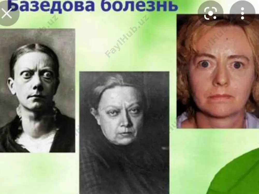 туришига, аёллар эса менструл циклининг бузилишига шикоят қиладилар. беморлар одатда ҳовлиқмароқ, бесарамжон, безовтароқ бўлишадилар. ортиқча ҳаракат қилишиб, кўпроқ гапирадиган бўладилар. кайфияти тез ўзгарувчан бўлади. агар касаллик эпифизар тоғайланиш давригача бошланган бўлса бўйи (бўй ўсиши одатдагидан тезлашган бўлиб тенгқурларидан бўй узунлиги юқори бўлади) нормадан баландроқ бўлади. беморларнинг ташқи кўринишидан баджаҳл, ғазабли, қўрқган қиёфада бўлади ( репрев –меликов симптоми). териси илиқроқ, юқалашган, намлиги бироз ошган. 2. диффуз-зарарли бўқоқ касаллигининг клиникаси,текширув усуллари - касаллик катта ёшдаги одамлардан фарқли ўлароқ, болаларда қалқонсимон безнинг катталашиши нисбатан кучлироқ бўлади. - шикоятлари асосан бош оғриги, эслаш қобилиятининг сусайиши - бўй ўсиши ва суякланиши одатдагидан бироз тезлашган. - жинсий ривожланишдан орқада қолади. - юрак етишмовчилиги камдан-кам ҳолларда қайд қилинади. - тиреотоксик криз ҳам жуда кам ҳолларда учрайди. - тимико-лимфатик ҳолат кўпроқ қайд қилинади. дтб касаллигининг болаларда клиник кечиши хусустиятлари қон зардобидаги умумий тироксин ва трийодтиронинни аниқлаш трийодтрионин гормони миқдорини аниқлаш қалқонсимон безни утт қалқонсимон безни сканограмма қилиш диагностикаси. …