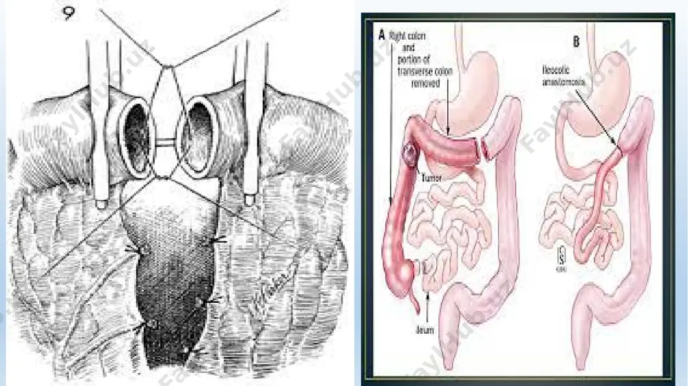 larni qursoq parda bilan birgalikda qorin devoridagi anatomik va patologik teshiklar orqali terini ostiga tushishi. dabba uchta elementdan tashkil topgan – daba teshigi daba xaltasi – qursoq parda va uni ichiga tushgan organlar. agar organlar terini ostiga qursoq pardasiz tushgsa, ya’ni muskullarni yorilishida, bunday patologiya prolapsus deb ataladi. kelib chiqish sabablariga ko’ra daba: a) tug’ma va b) ortirilgan bo’ladi. birinchisi anatomik teshik yopilmasa yoki xaddan tashqari katta bo’lsa hosil bo’ladi. ikkinchisi – shikastlanish yoki operasiyadan keyin hosil bo’ladi. joylashi bo’yicha dabbalar quyidagilarga bo’linadi: kindik, chot, qorin yonbosh devori, chov kanali urug’don xalta (intravaginal) diafragmal, umurtqa pog’onasi va boshqalar. klinik belgilarga qarab dabba kuyidagilarga bo’linadi: to’g’ri bo’ladigan – organlar bemalol qorin bo’shlig’iga tushib chiqib yuradi. to’g’ri bo’lmaydigan – organ xalta bilan yopishganda qisilgan – ikkiga bo’linadi – interstisial to’qima bilan qisilishi (xalqa), axlat bilan qisilish, bu daba xavfli bo’lib hisoblanadi. b) kindik dabbasida operasiya o’tkazish texnikasi. tayyorgarlik – hayvon 12 soatli …