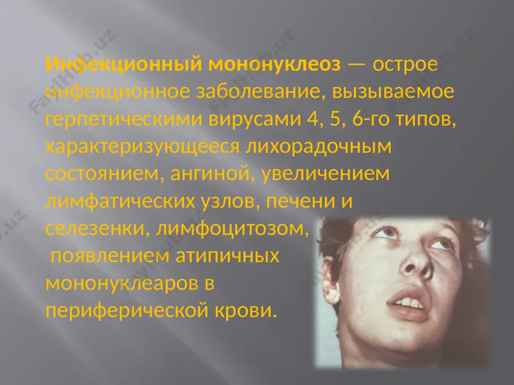 iya, agranulotsitoz, gemofagotsitarniy sindrom, infektsionno-toksicheskiy shok. bakterialnie: pnevmoniya, stomatit, otit, sinusit, mastoidit, sialoadenit, paratonzillit, gnoyniy limfadenit, abstsess i dr. vozmojno neskolko variantov isxoda ostrogo infektsionnogo protsessa: • vizdorovlenie (dnk virusa mojno viyavit tolko pri spetsialnom issledovanii v edinichnix v-limfotsitax ili epitelialnix kletkax); • bessimptomnoe virusonositelstvo ili latentnaya infektsiya (virus opredelyaetsya v slyune ili limfotsitax pri chuvstvitelnosti metoda ptsr 10 kopiy v probe); • xronicheskaya retsidiviruyushaya infektsiya: a) xronicheskaya aktivnaya veb-infektsiya po tipu xronicheskogo infektsionnogo mononukleoza; b) generalizovannaya forma xronicheskoy aktivnoy veb-infektsii s porajeniem tsns, miokarda, pochek i dr.; v) veb-assotsiirovanniy gemofagotsitarniy sindrom; g) stertie ili atipichnie formi veb-infektsii: dlitelniy subfebrilitet neyasnogo geneza, klinika vtorichnogo immunodefitsita — retsidiviruyushie bakterialnie, gribkovie, chasto mikst-infektsii respiratornogo i jeludochno-kishechnogo trakta, furunkulez i drugie proyavleniya; po dlitelnosti: ostroe (do 3 mes) zatyajnoe (do 6 mes) xronicheskoe (svishe 6 mes) osobennosti infektsionnogo mononukleoza u detey rannego vozrasta. vstrechaetsya reje, protekaet, kak pravilo, v bessimptomnoy forme. pri klinicheskoy …