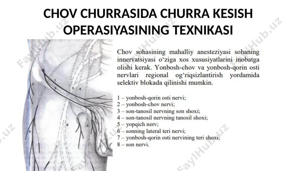 ng ikkita tutami qisqichlar orasida kesiladi (kremasterni rezeksiya qilish), va cho‘ltog‘i ligaturalar bilan bog‘lanadi urug‘ tizimchasiga o‘rnatilgan ushlagichni sekinlik bilan traksiya qilish orqali, va zarurat bo‘lganda churra xaltasini dyuval qisqichi bilan ushlab olish, churra xaltasini urug‘ tizimchasidan va ko‘ndalang fassiyadan o‘tkir va tumtoq yo‘l bilan sekin-asta ajratish imkonini beradi (churra xaltasining disseksiyasi). bitishmalar ko‘p bo‘lganida va noaniq vaziyatlarda churra xaltasini aynan shu disseksiya vaqtida kesib ochish tavsiya etiladi. churra xaltasi bo‘yinchasining disseksiyasi: churra xaltasini disseksiya qilish ko‘ndalang fassiyadagi nuqsongacha davom etilishi kerak. agar qiyshiq chov churrasida nuqson chov kanalining ichki halqasida joylashgan bo‘lsa, bunda uni to‘liq ajratib olish kerak bo‘ladi. urug‘ chiqarish yo‘li va urug‘ tizimchasi venalarini identifikatsiyalash uchun urug‘ tizimchasi disseksiyasini chov kanalining ichki halqasigacha davom ettirish lozim. churra xaltasi chov kanalining ichki halqasidan har tomondan ajratib olinadi va ko‘ndalang fassiya bilan bog‘langan bitishmalardan ozod qilinadi. urug‘ tizimchasining tashqi (kremaster) venalarini kesish: pastki qorin osti venalariga quyiladigan tashqi kremaster …