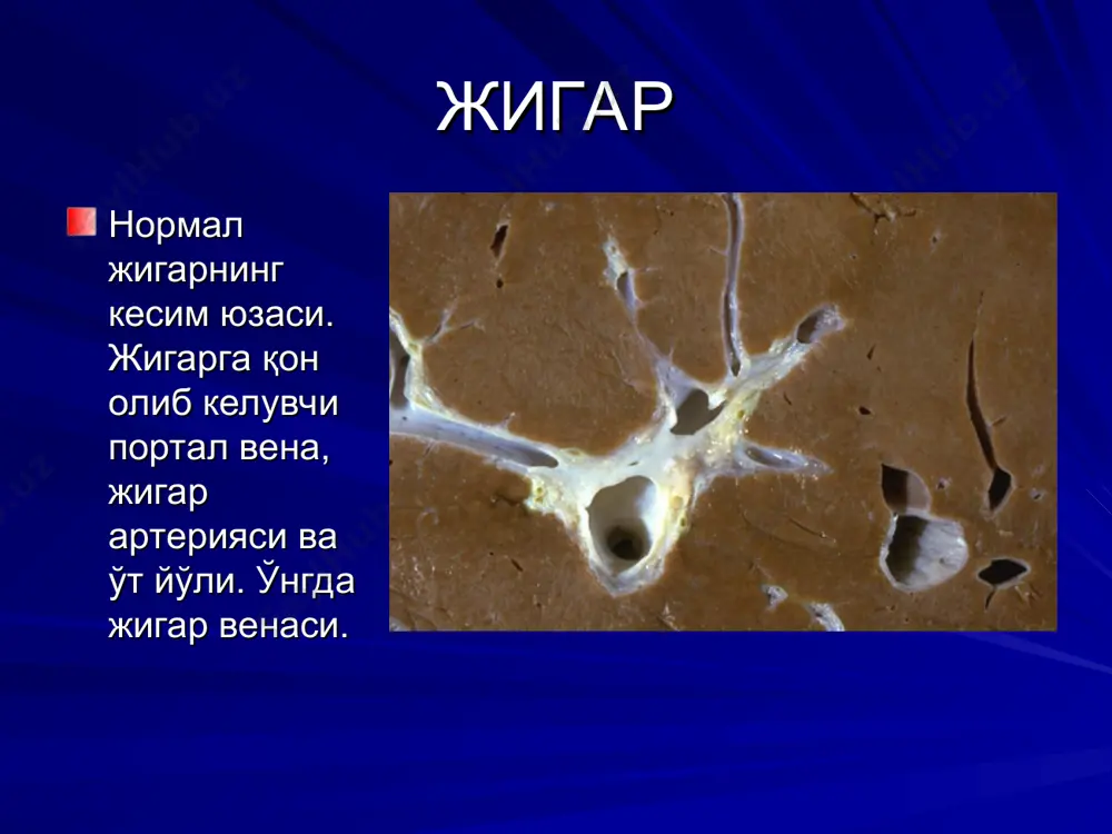 лган булиб,рнк тутади, катталиги 32-34 нм, caliciviridae синфига киради. сув оркали юкади. инкубацион даври 2-8 хафта, фульминант формаси 0.3-3% касалларда ва 20% хомиладор аёлларда кузатилади. вирус ташувчанлик ва гепатокарциномалар келиб чикиши аникланмаган. уткир ва сурункали гепатитлар уткир вирусли гепатит уткир вирусли гепатит экссудатив ва продуктив булиши мумкин. продуктив гепатоцитлар дистрофияси ва некрози, лимфомакрофагал элементларни реакцияси билан характерланади. фульминант гепатит (макро) фульминант гепатит (микро) уткир вирусли гепатит сурункали вирусли гепатит сурункали вирусли гепатит жигар тукимасининг паренхиматоз элементларини деструкцияси, стромада хужайра элементлари инфильтрацияси, склероз ва регенерация билан изохланади. сурункали персистирланувчи вирусли гепатит. сурункали вирусли гепатит. сурункали вирусли гепатит. алкоголли гепатит гепатоцитларда кескин ёг дистрофияси, майда некроз учоклари мавжуд. гепатоцитлар ва экстрацеллюляр сохада куп микдорда алкоголли гиалин аникланади. некрозга учраган гепатоцитлар атрофида лейкоцитлар аралашган хужайра элементлари жойлашади. агар алкогол истеъмол килиниши тухтатилса жигар структураси асл холатига кайтади. лекин купинча стромада фиброз тукимаси ривожланиб, кейинчалик зурайиб боради. айнан шундай холат сурункали алкоголли гепатитни изохлайди. …