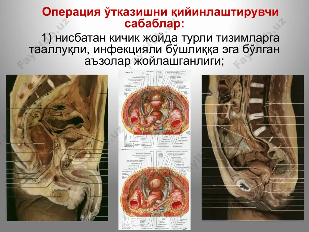 а кучли оғриқларга сабабчи бўлади. қовуқ олди клетчатка бўшлиғи орқада қовуқ олд девори, олдинда – қов суяклари ва қорин олд девори билан чегараланади, юқорида киндиккача тарқалади. бу бўшлиқ сон канали клетчаткаси билан, томир лакунаси орқали соннинг олд-ички қисми билан туташган. бу ердаги йиринг кўндаланг фасцияни эритиб, киндик орқали ташқарига чиқиши мумкин. бўшлиқни қов устидан оқ чизиқ бўйича ёки тўғри мускулларнинг бири орқали (рейн бўйича) очиш мумкин. йиринг чуқурроқда бўлганида оралиқ соҳаси ёки ёпқич мембранаси орқали очиш - буяльский-мак-уортер бўйича. параметритларни дренажлашнинг икки усули мавжуд: қорин олд девори (чов бурмасига параллел кесиш) орқали, қин гумбази орқали (бунда ён томондаги сийдик найи ва бачадон томирлари шикастланиши мумкин). тос аъзолари иннервацияси симпатик: - аорта чигали - ёнбош артериал чигаллар - пастки тутқич артерия чигали бел ва чаноқ симпатик чигаллари. парасимпатик: n.splanchnicis pelvini. соматик: - думғаза нерв чигали жинсий нерв. автоном: мояк ва тухумдон артерияси ва артерия атрофи чигаллари. тос аъзоларининг қон билан таъминланиши …
