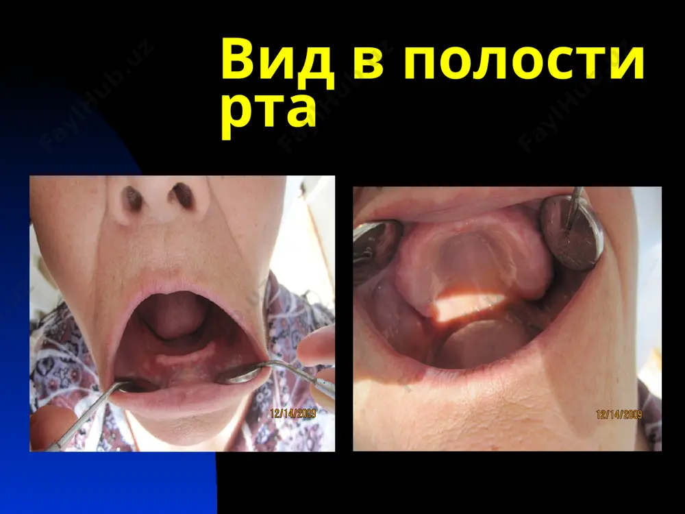 еолярного гребня а — треугольно-остроконечная; б — усеченного конуса; в — прямоугольная а б в форма и рельеф альвеолярного гребня г — шиловидная; д -полуовальная; е — уплощенная; ж — шишковидная. г д ж старческая прогения прогрессирующая атро­фия щечной мышцы обследование больных с беззубыми челюстями существует ряд особенностей в обследовании пациен­тов с полной потерей зубов. обследование начинают с опроса больного, во время которого выясняют: 1) жа­лобы; 2) время и причины потери зубов; 3) пользо­вался ли больной ранее съемными протезами. среди субъективных жалоб, которые предъявляют пациен­ты, - эстетическая неудовлетворенность: западение губ и щек, старческий вид, заеды, нарушение функций жевания и речеобразования. у лиц, обращающихся повторно, встречаются жалобы на плохую фиксацию имеющихся протезов. если ранее были изготовлены протезы, но пациент не пользовался ими, следует под­робно выяснить причины, а также тщательно осмот­реть прежние протезы. обследование больных с беззубыми челюстями после опроса переходят к осмотру лица и полос­ти рта. лучше это сделать незаметно во …