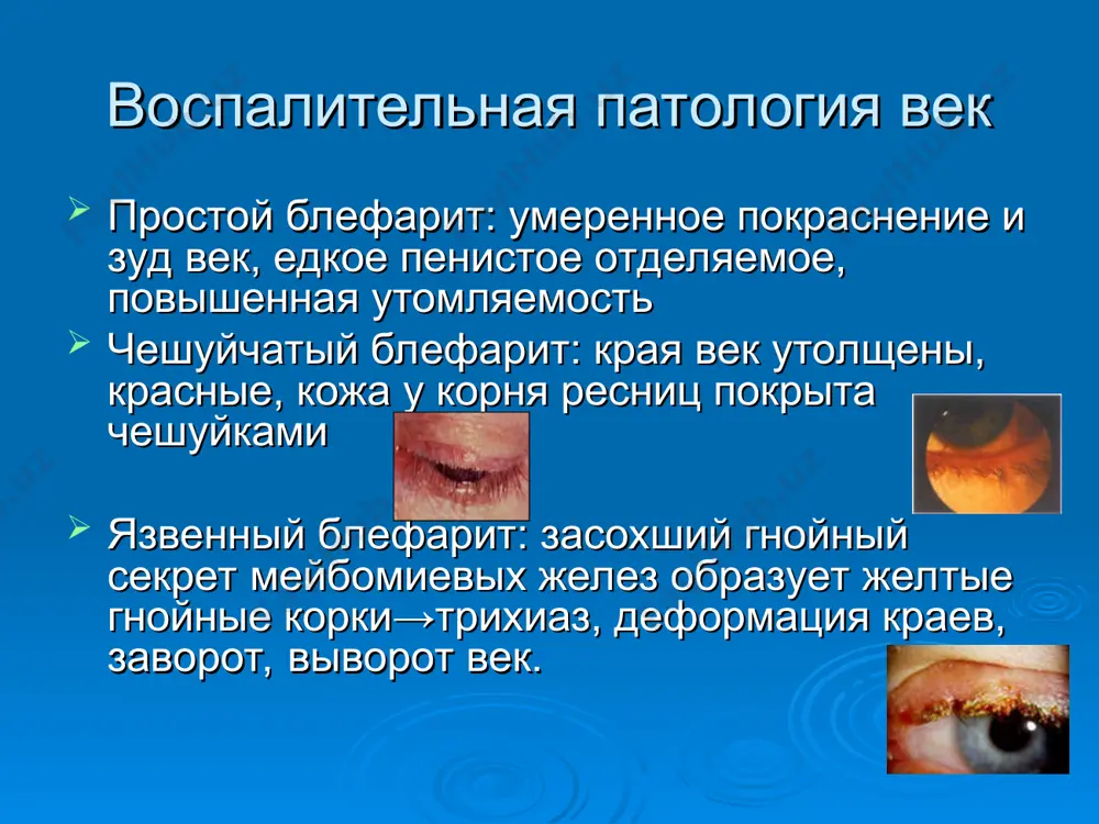 ениями в слезоотводящей системе) - рефлекторная гиперпродукция слезной жидкости (патология носа и придаточных пазух. - рефлекторное слезотечение (раздражение тройничного, лицевого и симпатического нервов) патология слезоотводящих путей патология слезных точек (сужение, заращение, эктопия) рубцовый выворот век, смещение их халязионом, кистой, опухолью деструкция и облитерация после ожогов врожденные аномалии слезных точек нарушение проходимости слезных канальцев сужение просвета вследствие отека при восп. процессах рубцовые стриктуры и заращения инородные тела, грибковые конкременты в просвете канальцев врожденная атрезия слезно-носового протока (дакриоцистит новорожденных) патология слезного мешка сужение носослезного прохода и отек слизистой слезного мешка рубцовое стенозирование и заращение при воспалении травматичекое повреждение ткани мешка при переломах верхней челюсти обтурация растущими опухолями слезотечение при неврологической патологии стомато-офтальмологические синдромы синдром чарлена – назорефлектроная офтальмия синдром фотергиля – слезо+слюнотечение+боли по ходу тройничного нерва синдром гортона – интенсивные лицевые боли со слезотечением, водянистыми выделениями из носа и гиперемией конъюнктивы слезотечение при неврологической патологии синдром сладера – болевые пароксизмы вокруг глаза …