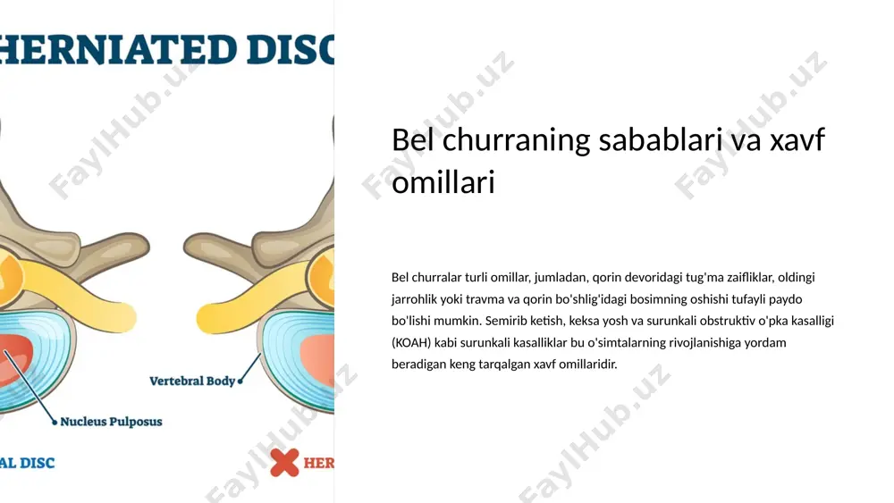 lashgan polipropilen kabi bardoshli, tejamkor variantlar. biologik to'r: hayvon yoki inson manbalaridan olingan bu tabiiy materiallar to'qimalarning o'sishi va yangilanishiga yordam beradi. mesh joylashuvi: bemorning anatomiyasi va jarrohning xohishiga qarab, to'r onlay, inley yoki sublay holatiga joylashtirilishi mumkin. 8 operatsiyadan keyingi parvarish va reabilitatsiya 1 og'riqni boshqarish bemorlarda operatsiyadan keyingi noqulaylik paydo bo'lishi mumkin. retsept bo'yicha og'riq qoldiruvchi dorilar, muz paketlari va yumshoq harakat og'riqni engillashtirishga yordam beradi va shifo beradi. 2 yarani parvarish qilish infektsiyani oldini olish uchun kesma joylari ehtiyotkorlik bilan tozalash va monitoringni talab qiladi. kiyinishni o'zgartirish va tikuvlarni olib tashlash sog'liqni saqlash guruhi tomonidan boshqariladi. 3 jismoniy terapiya keng qamrovli reabilitatsiya dasturi bemorlarga lomber mintaqada kuch, moslashuvchanlik va harakatchanlikni tiklashga yordam beradi. mashqlar va harakatlar har bir shaxsning rivojlanishiga moslashtiriladi. 9 bel churrani tuzatish natijalari va asoratlari bel churrani tuzatishning muvaffaqiyati turli omillarga, jumladan jarrohlik yondashuviga, ishlatiladigan to'r turiga va bemorning o'ziga xos xususiyatlariga bog'liq. umuman …