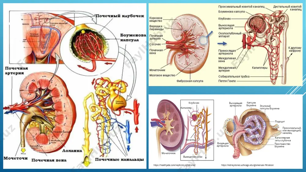 omi protienuriya (siydik bilan oqsil chiqishi), gematuriya (siydik bilan eritrositlar chiqishi), ba'zida leykosituriya(leykositlar chiqishi) bilan xususiyatlanadi. proteinuriya odatda baland emas (1-2 promille). o‘tkir glomerulonefrit uchun proteinuriyaning turg‘unsizligi, uning tezda yo‘qolishi xos. gematuriya barcha hollarda qayd etiladi (98% gacha), lekin uning darajasi katta chegarada o‘zgarib turadi. ko‘pchilik bemorlarda eritrositlar faqat mikroskop ostida aniqlanadi (ko‘rish maydonida 40 tagacha). kam hollarda (taxminan 13%) kasallik qonsimon, qo‘ng‘ir-qizil siydik chiqishi bilan kechadi. o‘tkir glomerulonefritning atipik kechishi kasallik boshlanishida tipik nefrotik sindrom, ifodalangan shish va massiv proteinuriya bilan namoyon bo‘ladi. bundan tashqari, o‘tkir glomerulonefrit boshlanishida o‘tkir yurak yetishmovchiligi sindromi kuzatilishi mumkin, ko‘pincha chap qorincha tipida, gipertonik ensefalopatiya (eklampsiya) va o‘tkir buyrak yetishmovchiligi juda kam uchraydi.yuqorida ko‘rsatilgan barcha sindromlar o‘zaro birga kelishi mumkin, siydik sindromi esa o‘tkir glomerulonefritning 98,4% hollarida uchraydi. notipik kechuvchi kasallikda faqat alohida siydik sindromi buyrakdan tashqari simptomlarsiz keladi va “nefritsiz nefrit” deb ataluvchi, ya'ni siydikdagi o‘zgarishsiz kechishi kuzatilishi ham mumkin. o‘tkir glomerulonefritda buyrak …