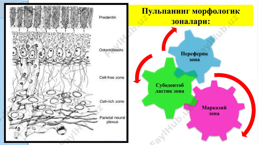 0; ўткир к 04.01; йирингли к 04.02; сурункали к 04.03; сурункали ярали к 04.04; сурункали гиперпластик к 04.05. ммси таснифи (1989): ўткир пульпит: ўчоқли диффуз сурункали пульпит: фиброз гангреноз гипертрофик сурункали пульпитни ўткирлашуви: пульпани қисман ёки тўлиқ олгандан кейинги ҳолат. пульпитларнинг этиологияси ва патогенези инфекцион омил ўткир механик жарохат сурункали механик жарохат кимёвий омил физик омил тиш бўшлиғига кариоз ковакдан инфекция ўтиши (схема) инфекцион омил – гемолитик ва ногемолитик стрептококклар, диплококклар, стафилококклар, гр+ таёқчалар, лактобациллалар, замбуруғлар. кариес ковак орқали дентин каналчалардан тиш бўшлиғини бехосдан очиб қўйганда чуқур патологик чўнтак орқали гаймор бўшлиғини яллиғланиши орқали қон ва лимфа томирлари орқали «юқорига йўналган» (ретроград) пародонтоген пульпит ўткир механик жарохат. тиш тож қисмини синиши тиш илдизини синиши тиш бўшлиғини бехосдан очиб қўйганда сурункали механик жарохат тишларни патологик едирилиши пломбани кўп қўйилиши дентиклни хосил бўлиши физик жарохат тишларни тўҳтамасдан, сувсиз чархлаш – қизиш натижаси амальгамали пломбани ажратувчи тагликсиз қўйиш ўтмас борлар билан тишни чархлаш …