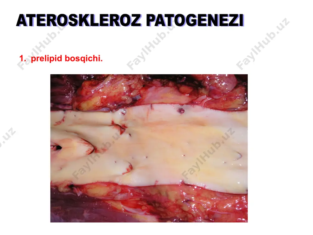 rent arteriolaning fibrinoid nekrozi (p.a.s.reaktsiya) —gofrirovkavahalokatendoteliyning bazal membranasi; — arteriolalarning spazmi; —plazma singdirishyokifibrinoid nekroziuning devorlari; —tromboz, loy hodisasi. yurak xurujlari, qon ketishi gipertonik kasallik preklinik bosqich. arteriolalarda keng tarqalgan o'zgarishlar bosqichi. organlardagi ikkilamchi o'zgarishlar bosqichi. kursning yaxshi varianti gipertonik kasallik gipertenziyaning tasnifi. kursning yaxshi varianti preklinik bosqich. (funktsional) bosqich. bosimning vaqti-vaqti bilan ortishi, arteriolalar va kichik arteriyalarning elastik tuzilmalari va mushak qavatining o'rtacha gipertrofiyasi, arteriolalarning spazmi, yurakning chap qorinchasining o'rtacha gipertrofiyasi. gipertonik kasallik kursning yaxshi varianti arteriolalarda keng tarqalgan o'zgarishlar bosqichi. plazma emdirish arteriolalar va kichik arteriyalarendotelial hujayralar, bazal membrana, mushak hujayralari va devorning tolali tuzilmalariga zarar yetkazadi. kelajakdavujudga keladiarteriolalarning gialinozi yoki arterioloskleroz. ko'pincha buyraklar, miya, oshqozon osti bezi, ichaklar, to'r pardasi, buyrak usti bezlarining arteriolalari va mayda arteriyalari plazma singdirilishi va gialinozga uchraydi. elastoz,elastofibrozvasklerozkatta arteriyalardan gipertonik kasallik gipertenziyaning tasnifi. kursning yaxshi varianti 3. organlardagi ikkilamchi o'zgarishlar bosqichi. kichik arteriyalar va arteriolalarning sklerozi va gialinozi - organlarda qon oqimining pasayishi. …