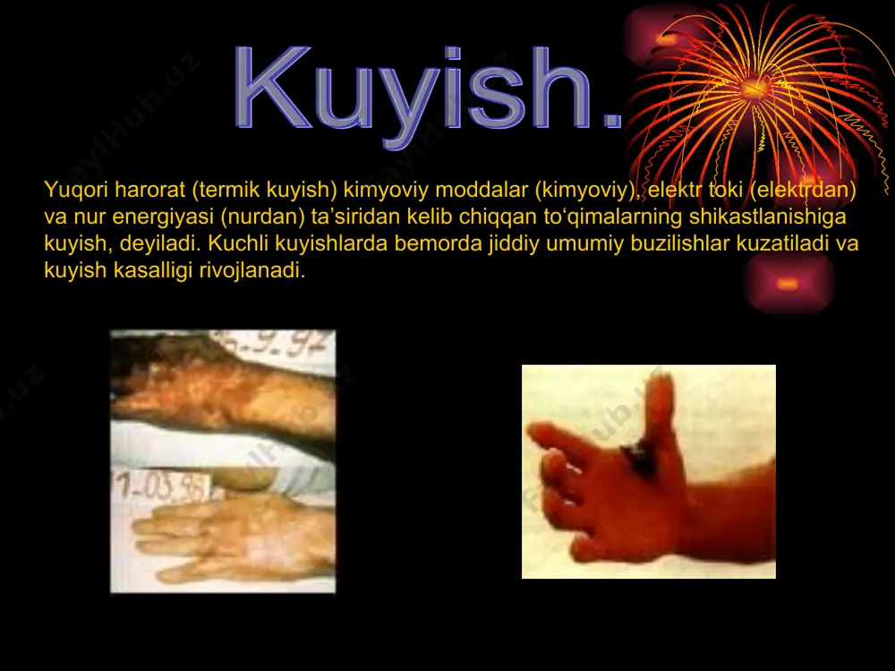 kislorod bilan ta’minlashning bosh manbai sifatida nafasni meyorlashtirish va inson organizmining xamma tukimalariga kislorod yetkazib beradigan kon aylanishini normalashtirish zarur. оказание помощи при ожогах iii, iv и v степени: elektr tokidan yoki boshqa baxtsiz xodisalarda jabrlanganlarga birinchi yordam. umumiy qoidalar. elektr tokidan yoki boshqa baxtsiz xodisalarda jabrlanganlarga birinchi yordam ko’rsatishda xarakatlarni tezqorligi, topkirlik va yordam ko’rsatayotgan insonning moxirligi muvaffakiyatni asosiy shartlaridir.biroq mazkur joriy qoidalarni bo’lishining zi kifoya emas.