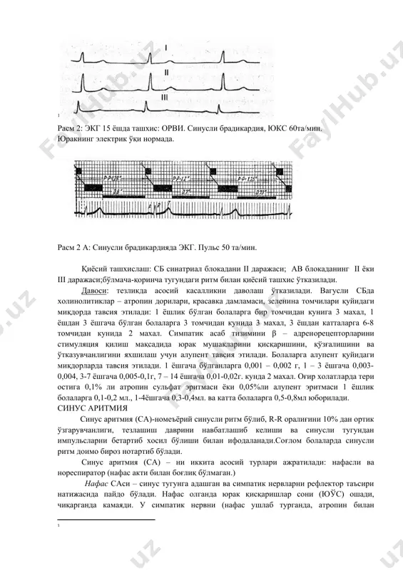 асаб тизимини β – адреноэргик блокаторлари (атеналол, изоптин) тавсия этилади. юрак етишмовчилиги кузатилганда ангиотензин пайдо килувчи фермент ингибиторларни : каптоприл, эналаприл тавсия этиш яхши самара беради. синус брадикардия синус брадикардия (сб) синус ритмни камайши билан ифодаланади (секин синус ритм) – бола хаётининг биринчи йилида минутига 100 тадан кам ва катта ёшдаги болаларда 80-60 тадан кам қисқариш кузатилади. унинг пайдо бўлиш сабаблари адашган нерв таранглигининг ошиши ёки симпатик нерв таранглигининг пасайиши, шунингдек синус тугун хужайраларига гипоксик, ацидоз, захарланишларнинг доимий таъсири натижасида юзага келишидир. этиология: сбни бир нечта турлари ажратилади. физиологик сб n.vagus таранглигининг ошиши ва спорт билан шуғулланувчи болаларда шунингдек ухлаганда дам олганда кузатилади. туғма сб бўлиши хам мумкин. мнснинг бир катор патологик касалликлар натижасида юзага келадиган невроген сб хам бўлади ва у мия ўсмаларига, менингитга, суяк-мия жарохатларига, шунингдек, ошқозон-ичак, жигар, гипотериоз касалликларга чалинган болаларда учрайди. сб баъзан миокарднинг оғир зараланганида (миокардитлар, миокардиосклероз) ва баъзи бир дориларни (β – адренергик блокаторлар, …