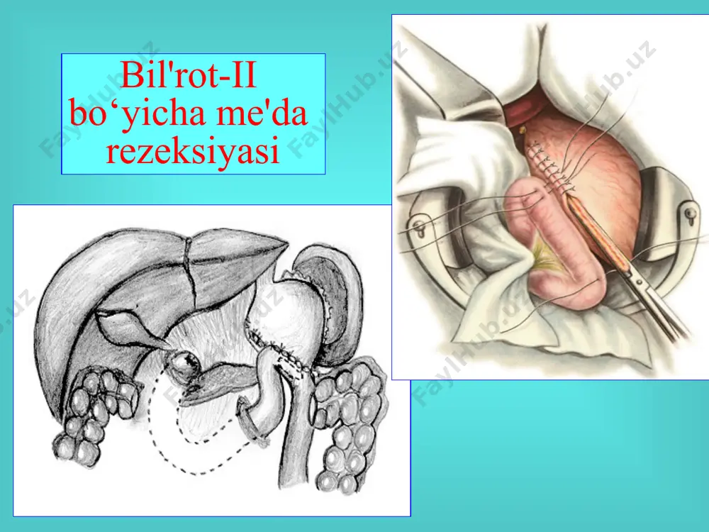 postgastrorezeksion sindrom - Page 3