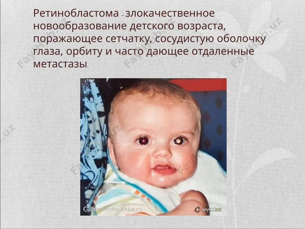 етастазирования. протекает с выявлением отдаленных диссеминированных очагов в костном мозге, печени, трубчатых костях, головном мозге, костях черепа. распространение ретинобластомы происходит по мягкой мозговой оболочке, зрительному нерву, лимфогенным и гематогенным путем. на этой стадии страдает общее состояние пациента: развивается интоксикация, слабость, мозговые симптомы (тошнота, рвота, головная боль). диагностика: дети с семейным анамнезом ретинобластомы должны находиться под постоянным наблюдением офтальмолога. биомикроскопию, прямую и обратную офтальмоскопию, визометрию, тонометрию, гониоскопию, исследование бинокулярного зрения, экзофтальмометрию, измерение угла косоглазия, узи глаза. для оценки распространенности : рентгенография орбиты, рентгенография околоносовых пазух, кт и мрт головного мозга, сцинтиграфия печени, остеосцинтиграфия. консультация педиатра, стоматолога, невропатолога, отоларинголога, ему выполняют анализы крови, мочи, рентгеноскопию органов грудной клетки. лечение: криотерапия и фотокоагуляция — два прекрасных метода лечения ретинобластом, позволяющие сохранить глаз и зрение и практически не дающие осложнений. в случае рецидива заболевания возможно повторение лечения. однако консервативное лечение эффективно только при небольших опухолях. криотерапия показана при поражении переднего отдела сетчатки, фотокоагуляция — …