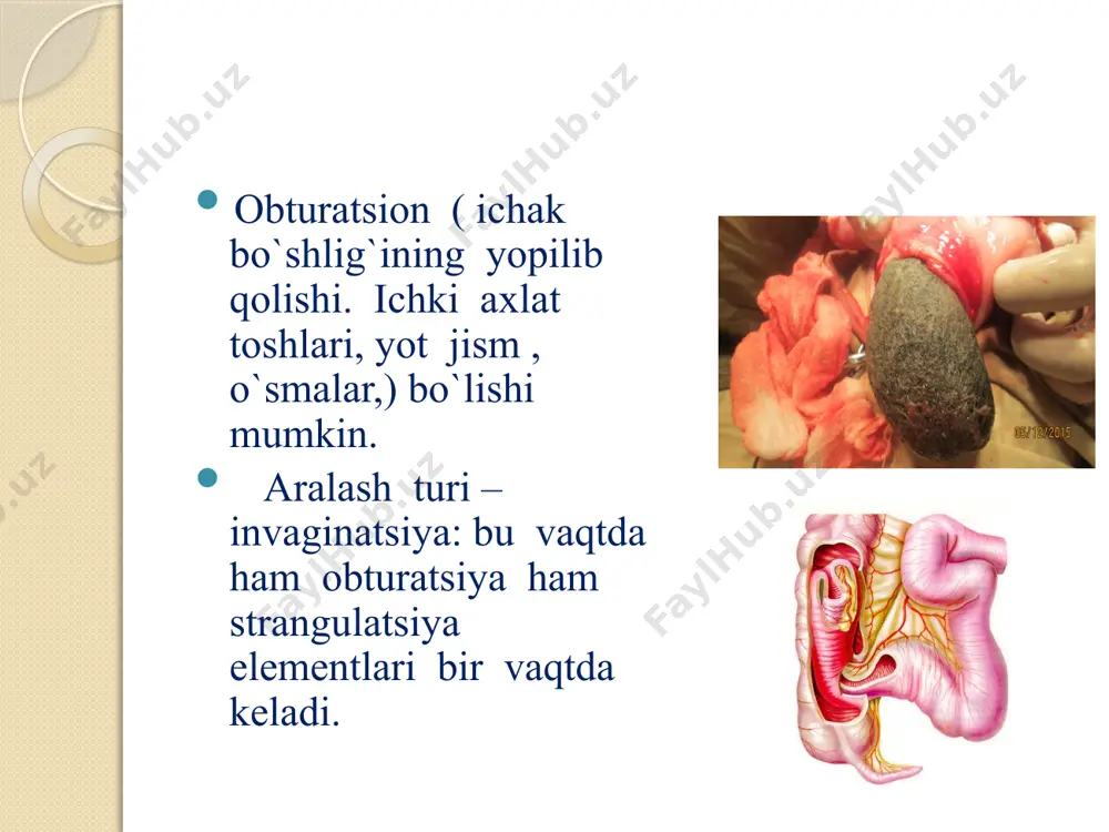 ishining sabablari: qorin oldingi devoriga yopishgan mekkel divertikuli, ichak tutqichining defekti, qorin ichi a`zolaridagi operatsiyalardan keyin hosil bo`lgan shursimon bitishmalar. klinik ko`rinishi: qorinda kuchli xurujsimon, og`riq bo`lishi, qusadi, axlat va gazlar chiqmaydi. dastlab qorin yumshoq, auskultatsiyada peristaltikaning kuchayganligi eshitiladi. keyinchalik qorin damlaydi. obzor rentgenogrammada ko`p sonli kloyber kosachalari ko`rinadi. konservativ davo: oshqozon dekompressiyasi yuvilishi og`riqsizlantirish, kerak bo`lsa cho`zilgan peridural anesteziya elektrolitlar buzilishini to`g`irlash gipertonik xuqna vena orqali peristaltikani stimullash (10 % nace 2,0 ml har bir yoshiga prozerax 0.05-0.1 ml har bir so`atda). operativ davo: laparotomiya va chaqiruvchi sababni bartaraf qilish. bitishmali ichak tutilishining tasnifi ertangi operatsiyadan keyin dastlabki 3 – 4 haftada rivojlanadi: (6 – 7 kungacha ) bitishmali – parolitik turi oddiy turi- 16 kungacha kechiktirilgan turi – 30 kungacha kechki bitishmali ichak tutilishi – operatsiyadan keyin bir oy va undan ziyod vaqt o`tgandan keyin rivojlanadi. qorin bo`shlig`i a`zolarida har qanday operatsiyadan keyin bitishmalar rivojlanadi. ayniqsa ichaklarning seroz …