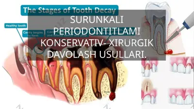 surunkali periodontitni konservativ-xirurgik davolash usullari — PPTX