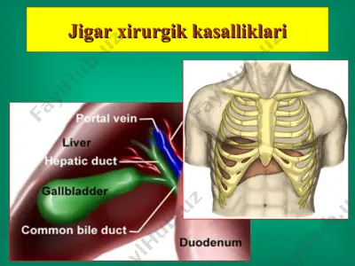 jigar xirurgik kasalliklari — PPT
