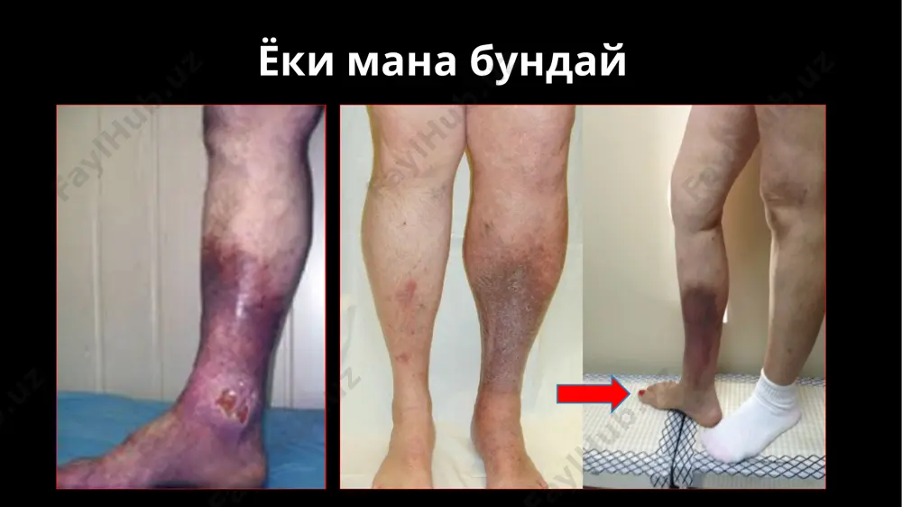 llarov v god, a v ssha – bolee 1 milliarda dollarov ejegodno. * uzbekiston 0,3-1,0% - 100 000 - 300 000 inson 4-5 mln. sum 300 000 - invalid chislennost naseleniya respubliki uzbekistan an segodnyashniy den sostavlyaet primerno 30 millionov. 0,3-1% iz 30mil eto- 100000-300000 lyudey imeyut xvn v stadii troficheskix izmeneniy. mi priblizitelno podschitali zatrati u svoix bolnix i viyasnili chto kajdiy patsient sam tratit primerno v god 2,5-3 milliona sumov dlya lecheniya svoego zabolevaniya. xvn vizivaet ne tolko ekonomicheskie problemi ona vizivaet bolshie sotsialnie problemi to est primerno 300000 lyudey yavlyayutsya invalidami, teryaetsya kachestvo jizni etix bolnix * 1. vertikal reflyuksni bartaraf etish operatsiyasi 2. gorizontal venoz reflyuksni bartaraf etish operatsiyalari 3. chukur venalarda reflyuksni bartaraf etish operatsiyalari klapanlar intravazal korrektsiyasi: sun'iy klapanlar: klapanlar transplantatsiyasi 4. aynalma yullar xosil kilish operatsiyalari linton operatsiyasi mnogoletniy mejdunarodniy opit primeneniya operatsii lintona i ee modifikatsiy, s odnoy storoni, podtverdil visokuyu effektivnost …