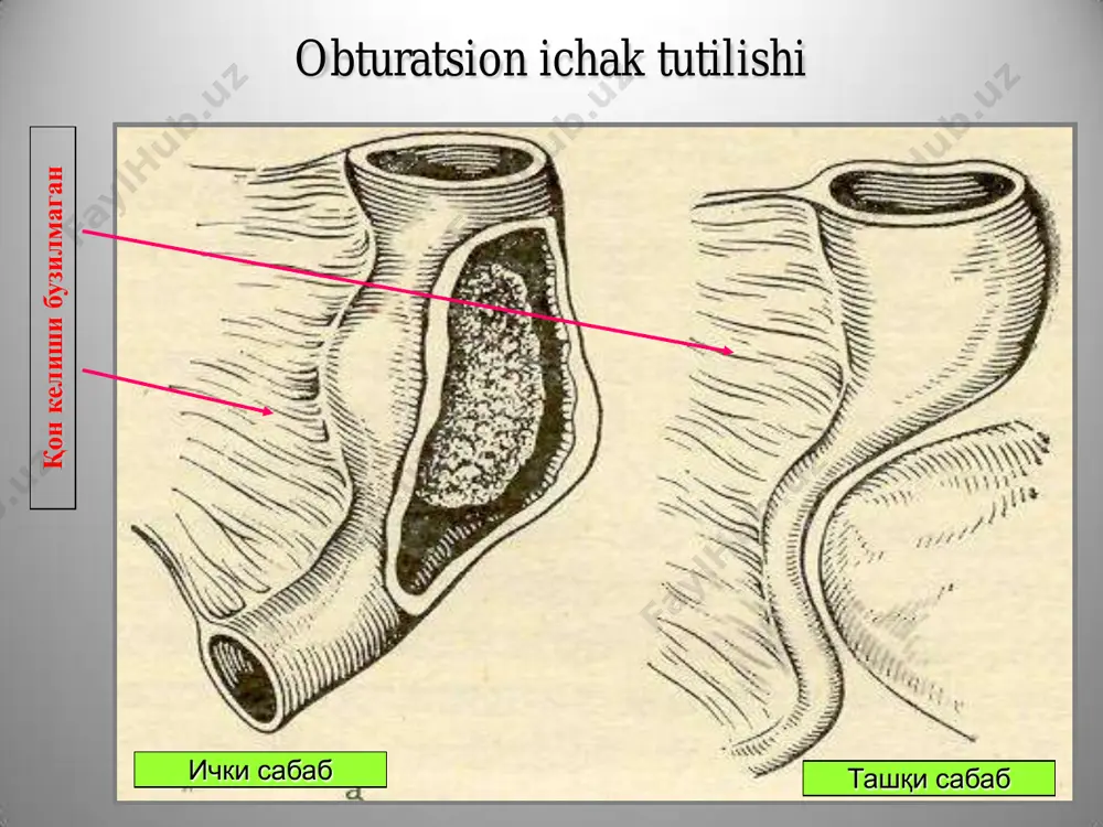oʼtkir ichak tutilishi turlari va ularning klinalik koʼrsatkichlari - Page 5