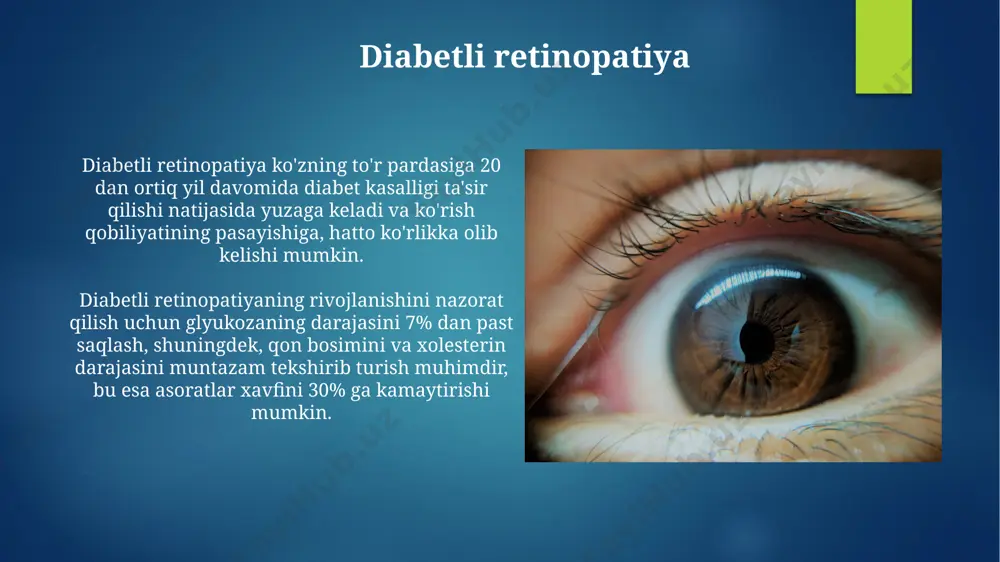t: ta'rifi va turlari uveit diagnostikasi biomikroskopiya, fluoresteyndiy angiografiya va optik koherent tomografiya (okt) kabi ko'rish tekshiruvlarini o'z ichiga oladi, shuningdek, yallig'lanish darajasini va turini aniqlash uchun qon tahlillari o'tkaziladi. uveitning uchta asosiy turi mavjud: oldingi uveit (iris va siliar tanani qamrab oladi), oraliq uveit (siliar tanani va shishasimon tanani) va orqa uveit (tor qon tomirlari va to'r pardani). retinoblastomalar retinoblastomaning genetik sabablari, shu jumladan rb1 geni mutatsiyasi, kasallikning 40% dan ortiq holatlarida aniqlanadi. retinoblastomaning 60% dan ortiq hollari 5 yoshgacha bo'lgan bolalarda uchraydi va ko'zning oq rangli qismida oq dog' yoki qora nuqta sifatida namoyon bo'lishi mumkin. katarakta: patogenezi va klinik ko'rinishi kataraktaning klinik ko'rinishi ko'rishning asta-sekin pasayishi, yorug'likka sezgirlikning oshishi va "halolarning" paydo bo'lishi bilan namoyon bo'ladi. katarakta rivojlanishida 60 yoshdan oshganlarda 50% dan ortiq ehtimollik kuzatiladi, bu asosan linzaning tabiiy qarish jarayoni bilan bog'liq. e'tiboringiz uchun rahmat @taqdimot_robot image6.jpg image7.jpg image8.jpg image9.jpg image10.jpg image11.jpg image12.jpg image13.jpg image14.jpg …