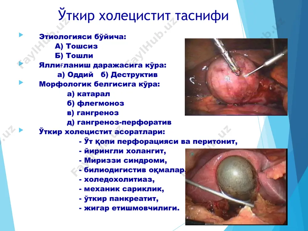 ўткир тошли холецистит - Page 3