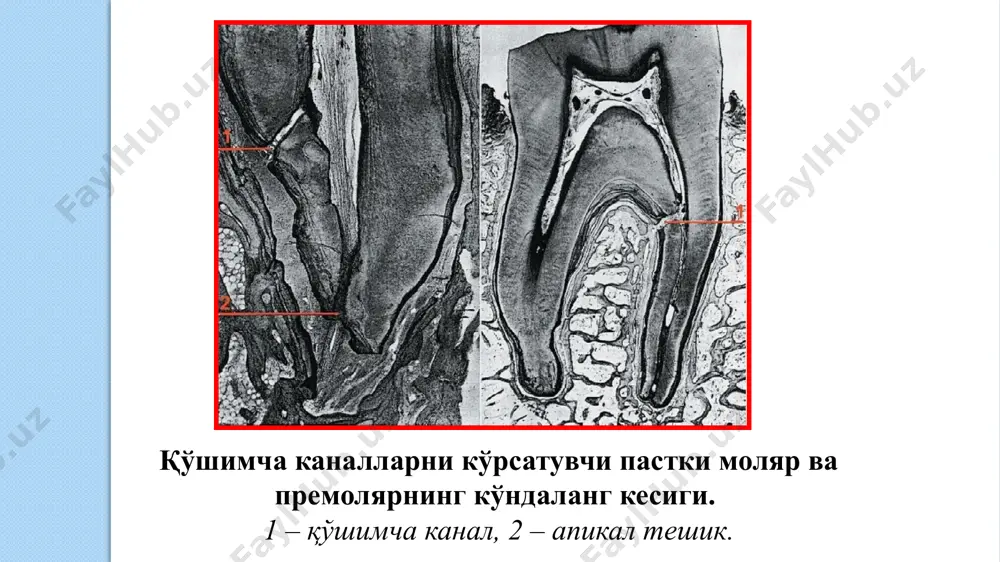 ия, рибосома, лизосомалар бўлади. лимфоцитлар ҳимоя вазифасини бажаради. илдиз пульпаси – периодонт ва умумий қон ва нерв томир тизими билан боғланган бўлиб, тож пульпасидан фарқли равишда толаларга бой бўлади. хужайра элементлари кам. тож пульпаси – хужайра элементларига, қон томир тутамлари ва нерв чигалларига бой бўлади. пульпанинг толалари: коллаген толалар – тож пульпада турли ориентацияда бўлиб, тўр хосил қилади, тож пульпасининг переферик соҳасида зич тутамлар кўринишида бўлади. илдиз пульпасида узунасига, зич тутамлар ҳосил қилади. ретикуляр толалар – бутун пульпа бўйлар тўр хосил қилиб жойлашади. дентин хосил бўлишида, булар қалинлашади ва переферик пульпада сони ортиб боради. окситалан толалар – асосан пульпани переферик соҳасида кўп бўлиб, қон томирлар билан бирга жойлашади. эластик толалар – фақат томир деворлари олдида учраши мумкин. пульпанинг асосий моддаси: сийрак толали бириктирувчи тўқима кўринишида бўлади. гель кўринишида бўлади. таркиби: мукопротеин, мукополисахарид (гликозамингликан), гликопротеин, сув. асосий моддада кечувчи алмашинув жараёнлари пульпани физиологик хусусиятларини белгилайди ва унинг хаётчанлигига таъсир этади. тиш …