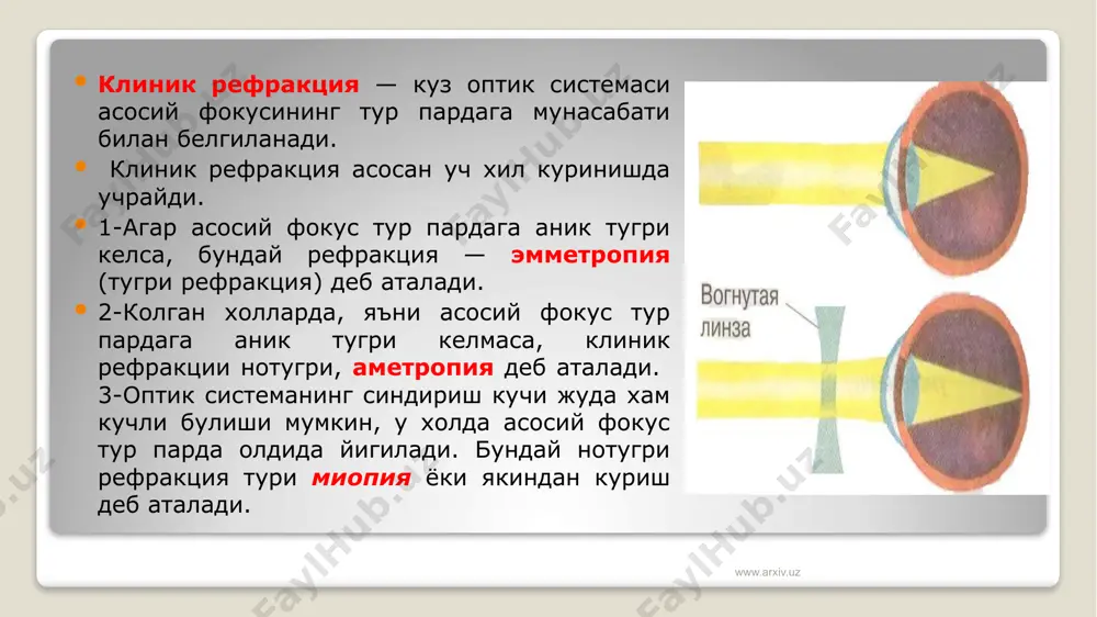 еш болаларда гиперметропик рефракциянинг 2 ва 3 боскичлари бинокуляр куриш фаолиятини ривожланишига салбий таъсир курсатади. натижада монокуляр куриш, амблиопия еки гилайлик каби хасталиклар келиб чикиши мумкин. бундан ташкари гипперметропик рефракциянинг турли боскичларида даволаниш анча мураккаб булган, конъюнктивит ва блефаритлар кузатилиши мумкин. шунинг учун гиперметропик рефракцияда биринчи омилларидан бири бу коррекция усулидир. гиперметропиянинг 2- ва 3-боскичларида асосан тулик мусбат коррекция берилади. кичик боскичли гиперметропияда эса юкорида курсатилган узгаришлар пайдо булиши белгилари куринганда коррекция килинади. www.arxiv.uz www.arxiv.uz 3. миопик рефракция кучли рефракция булиб, бу холда узокдан куриш ёмонлашади. миопия — нотугри рефракция турлари "ичида энг куп учраши, хамда турли асоратларга бой булиши туфайли офтальмологлар амалиётида куп ахамият бериладиган рефракция тури хисобланади. миопия хам 3 боскичга ажратилади; 1. купи боскич — 3 диоптрийгача. 2. урта боскич— 3 диоптрийдан 6 диоптрийгача. 3. юкори боскич — 6 диоптрийдан юкори. клиник куриниш бунича миопияни 2 тури фарк килинади; прогрессив булмаган ва прогрессив (усувчи). агар прогрессив булмаган …