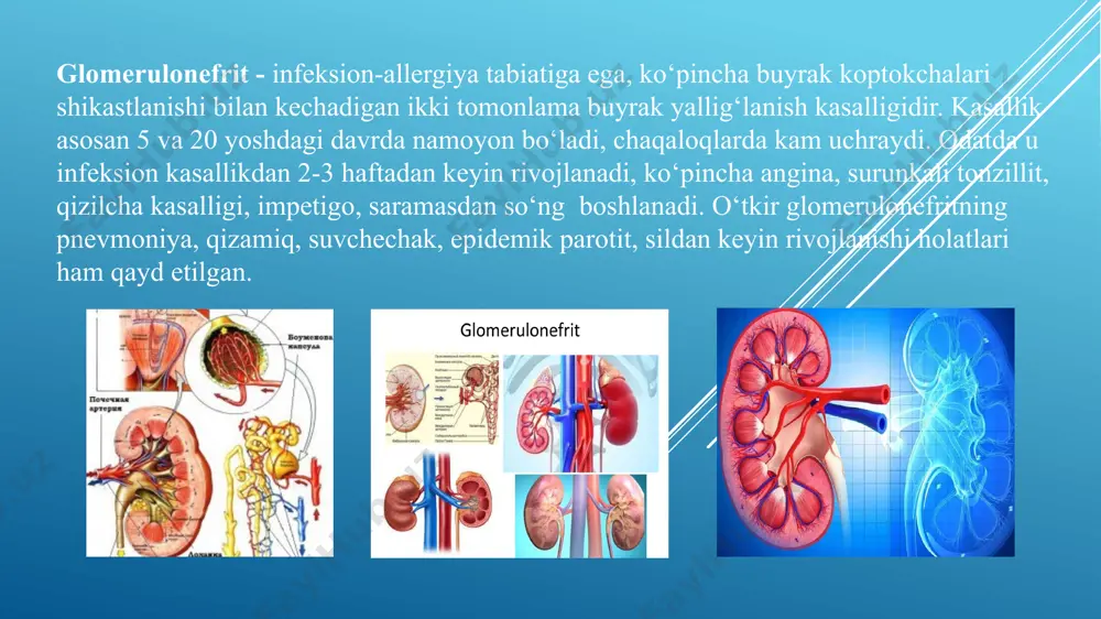 iydik bilan ko‘p miqdorda oqsil, eritrositlar, silindrlar chiqishi buyrakdan tashqari: kuchli bosh og‘rig‘i, yurak o‘ynashi, hansirash, ko‘ngil aynishi, ishtaha pasayishi bundan tashqari yana, kasallikning tipik kechishida belgilar sezilarli darajada va kuchli namoyon bo‘ladi: tana harorati oshadi, umumiy ahvol yomonlashadi, bosh og‘rig‘i, ko‘ngil aynishi, qayt qilish, beldagi og‘riqlar kelib chiqadi. birinchi kunlarda ajraladigan peshob hajmi kamayadi, proteinuriya, mikro va makrogematuriya kuzatiladi. peshob rangi xiralashadi – “go‘sht yuvindisi” rangini oladi. yuz va qovoqlarda shish paydo bo‘ladi. shishlar hisobiga bola tana vazni oshishi mumkin. arterial qon bosimi ortishi (140-160 mm.hg.ustuni) kuzatiladi. o‘z vaqtida va to‘g‘ri olib borilgan davo muolajalari natijasida bolalarda o‘tkir glomerulonefrit to‘liq tuzaladi va buyrak funksiyalar tiklanadi, to‘liq sog‘ayish 4-6 hafta muddatni o‘z ichiga oladi (o‘rtacha 2-3 oy). kam hollarda (1-2 %) o‘tkir glomerulonefrit surunkali shakliga o‘tib ketadi. o‘tkir glomerulonefritning kechishining birinchi 7-10 kunda kasallikning eng yorqin ko‘rinishi hodisalari qayd etiladi – bunga o‘tkir glomerulonefrit debyuti deb ataladi. bola teri rangi …