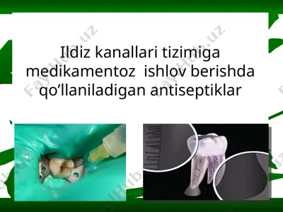 ildiz kanallari tizimiga medikamentoz  ishlov berishda qo’llaniladigan antiseptiklar — PPTX