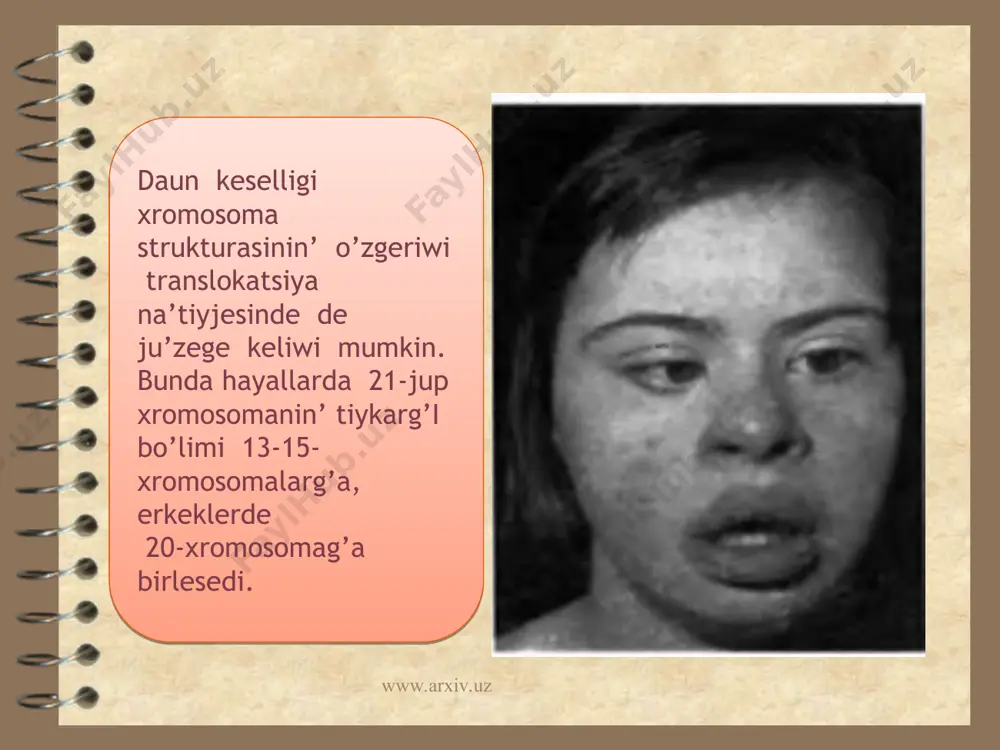 xromosoma kesellikleri, daun sindromi - Page 4