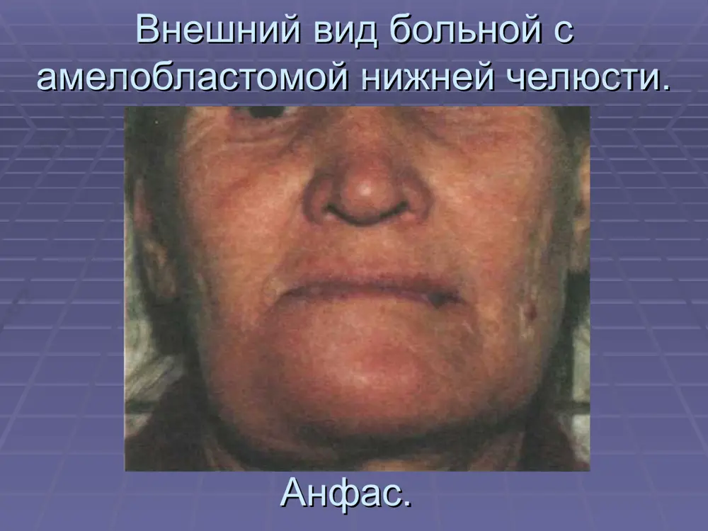 амелобластома - Page 4